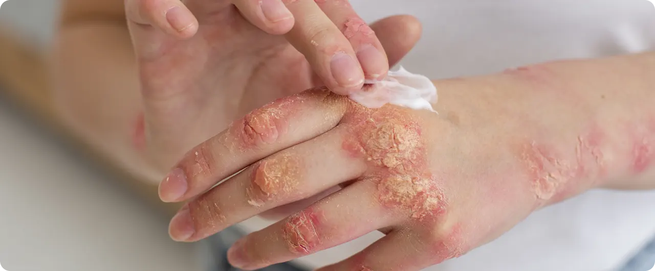 ¿Qué es la fiebre del mono? | ¿Qué es herpes zóster? 