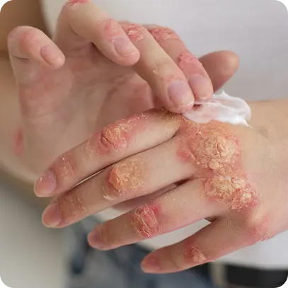 ¿Qué es la fiebre del mono? | ¿Qué es herpes zóster? ¿Qué es la fiebre del mono? | ¿Qué es herpes zóster?